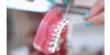 Czyszczenie aparatu ortodontycznego oraz implantów