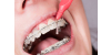 Leczenie ortodontyczne i produkty do pielęgnacji aparatu ortodontycznego