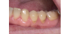Przyczyny i leczenie odsłoniętych szyjek zębowych