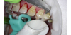 Piaskowanie zębów - co warto wiedzieć, na czym polega ten zabieg stomatologiczny?