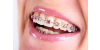 Do czego służą wyciągi ortodontyczne - najważniejsze informacje