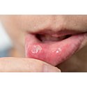 Mucocele