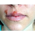 Opryszczka wargowa – czym jest wirus opryszczki zwykłej i jak wygląda jej leczenie opryszczki na ustach?