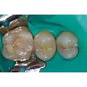 Fleczer stomatologiczny, kiedy i po co się dentysta go zakłada na ząb?