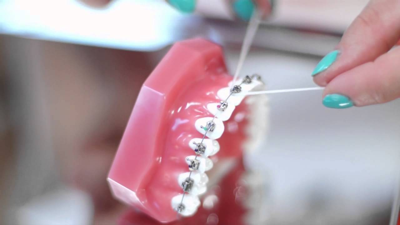 Ile trwa leczenie aparatem ortodontycznym - jak długo nosi się aparat ortodontyczny, aby mieć proste zęby?