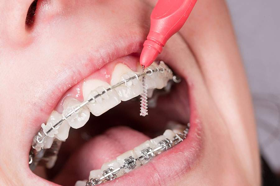 Leczenie ortodontyczne i produkty do pielęgnacji aparatu ortodontycznego