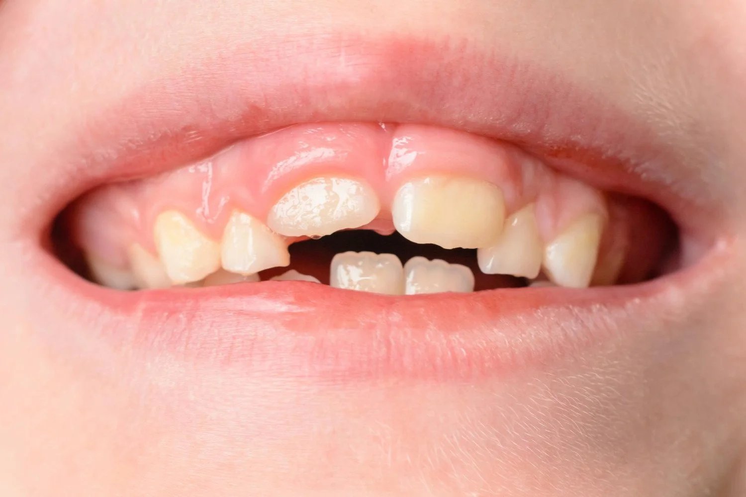 Czym jest diastema i jak wygląda leczenie przerwy między zębami?