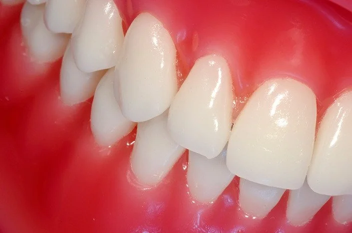 Leczenie dziąseł przy pomocy PERIO AID oraz Vitis Gingival