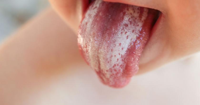 Grzybica jamy ustnej. Objawy i leczenie kandydozy jamy ustnej