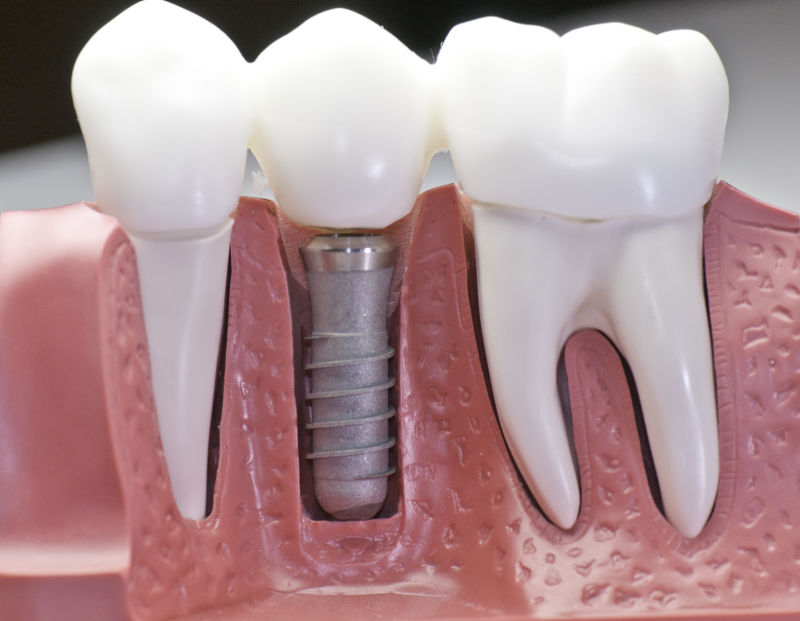 Czy implanty stomatologiczne z tytanu mogą uczulić?