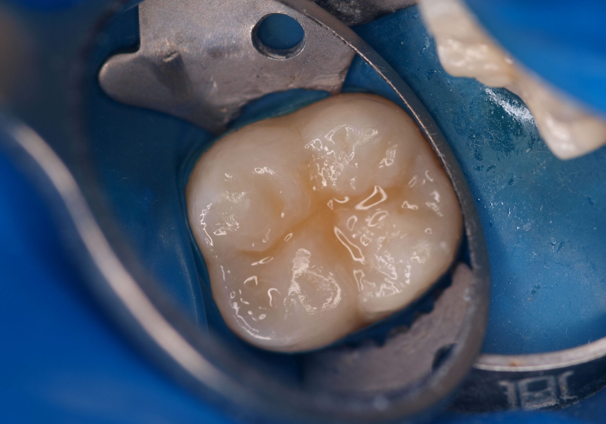 Lakowanie zębów u dzieci i dorosłych - korzyści, wskazania, na czym polega lakowanie zę-bów?