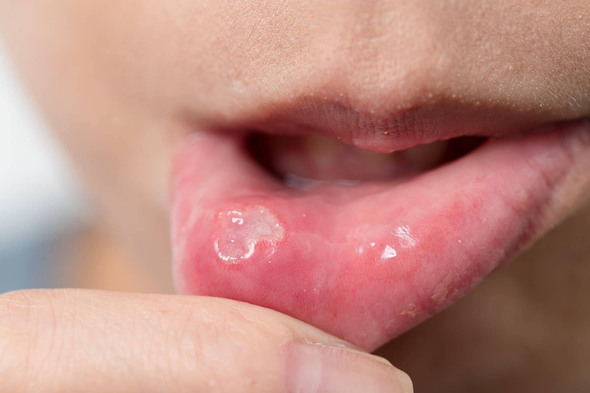 Mucocele