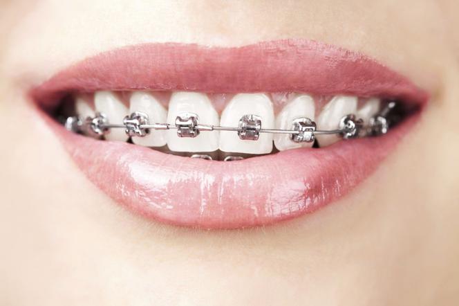 Ortolifting – sposób na zredukowanie zmarszczek poprzez założenie aparatu ortodontycznego. Na czym polega ortofilting?