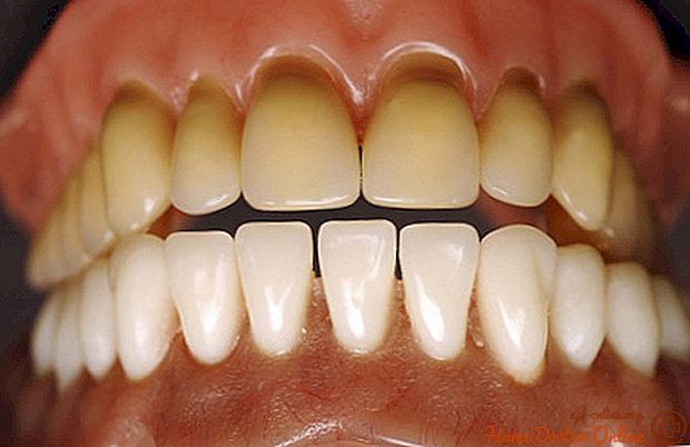 Jak usunąć przebarwienia zębów — skąd biorą się plamy oraz przebarwienia na zębach?