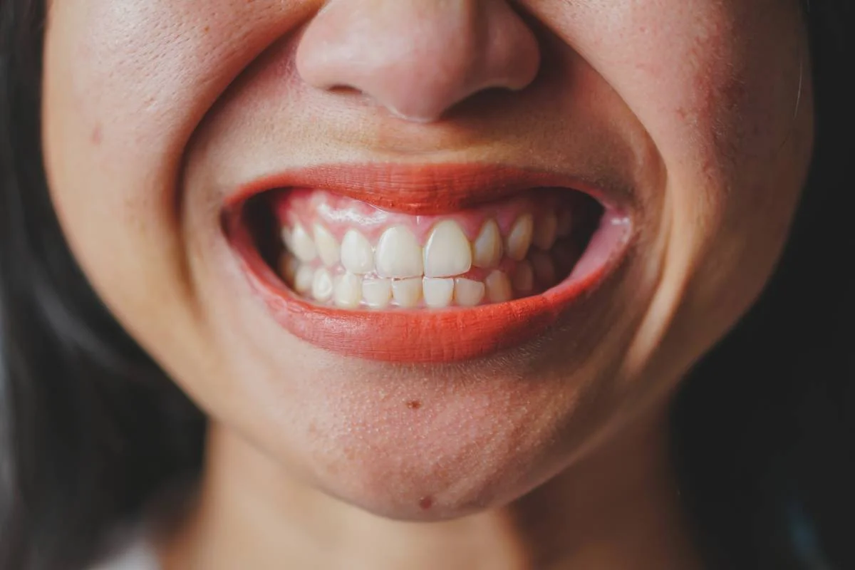 Uśmiech dziąsłowy (gummy smile) – co to jest i jak wygląda leczenie?
