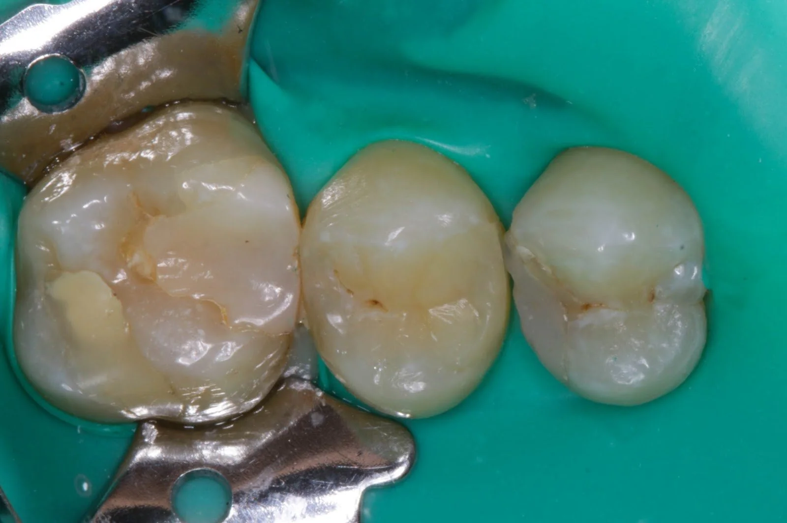Fleczer stomatologiczny, kiedy i po co się dentysta go zakłada na ząb?