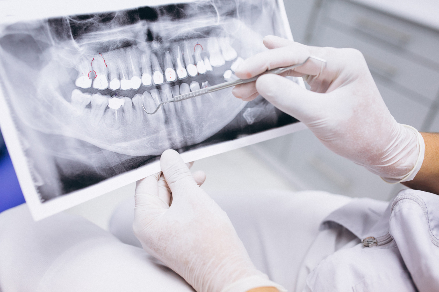Ząb zatrzymany – przyczyna silnego bólu.  Ile kosztuje usunięcie zatrzymanego zęba i czy to boli?