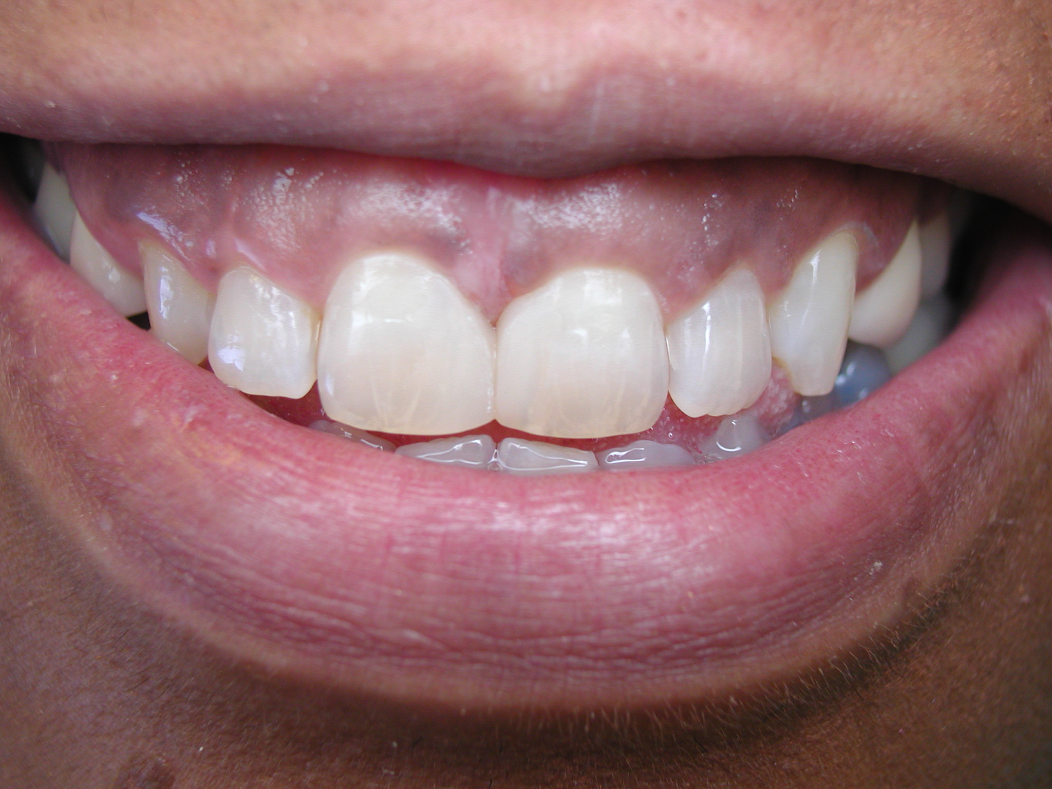 Bonding zębów – szybka metoda zmiany kształtu zębów. Na czym polega bonding zębów?