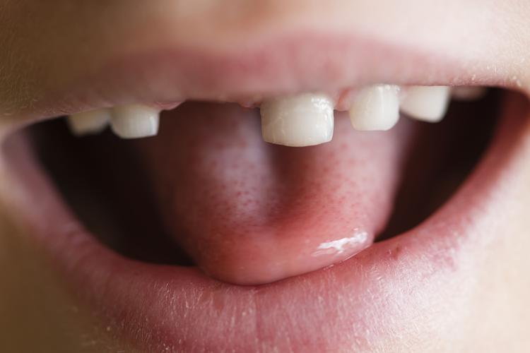 Zepsute zęby mleczne u dzieci - czy warto leczyć zęby mleczne dotknięte próchnicą?