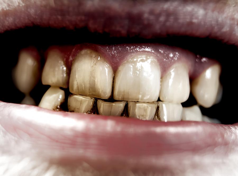Przyczyny niszczenia się zębów - dlaczego zęby się psują?