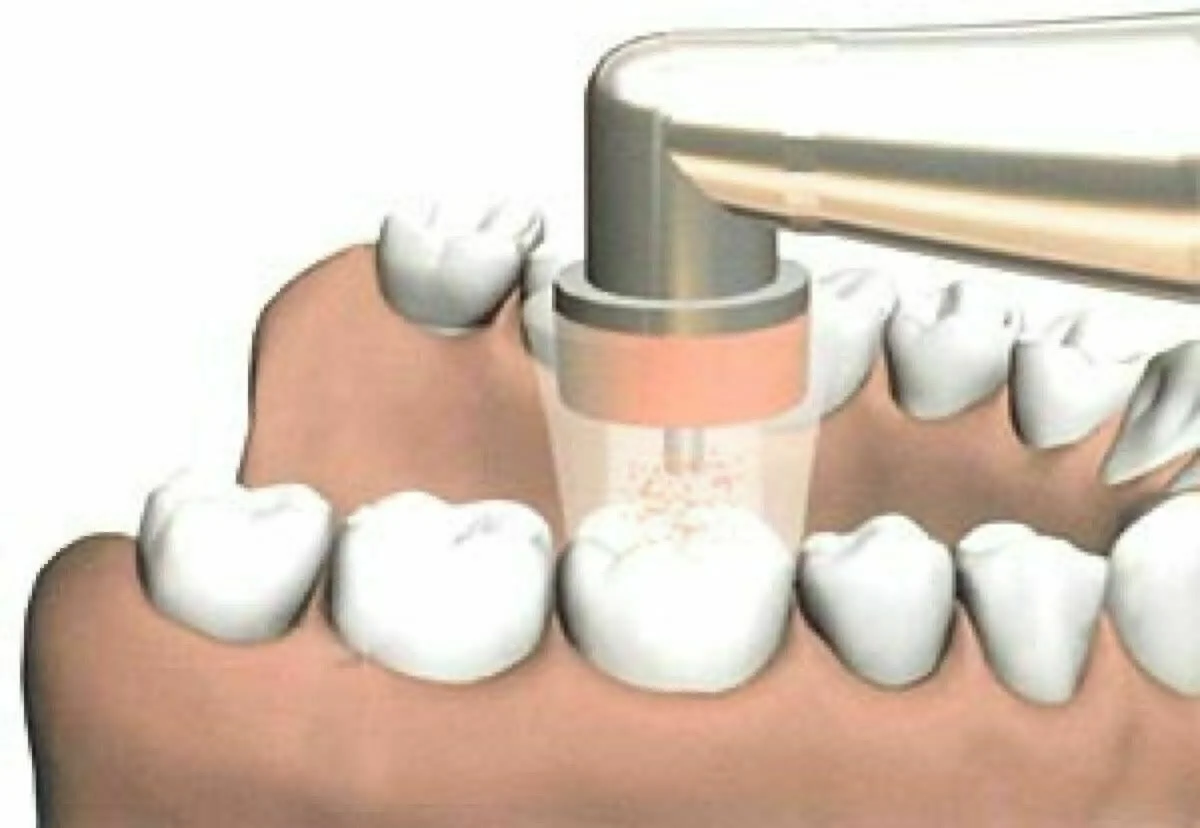 ozonoterapia dentysta