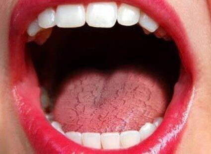 objawy suchosci jamy ustnej